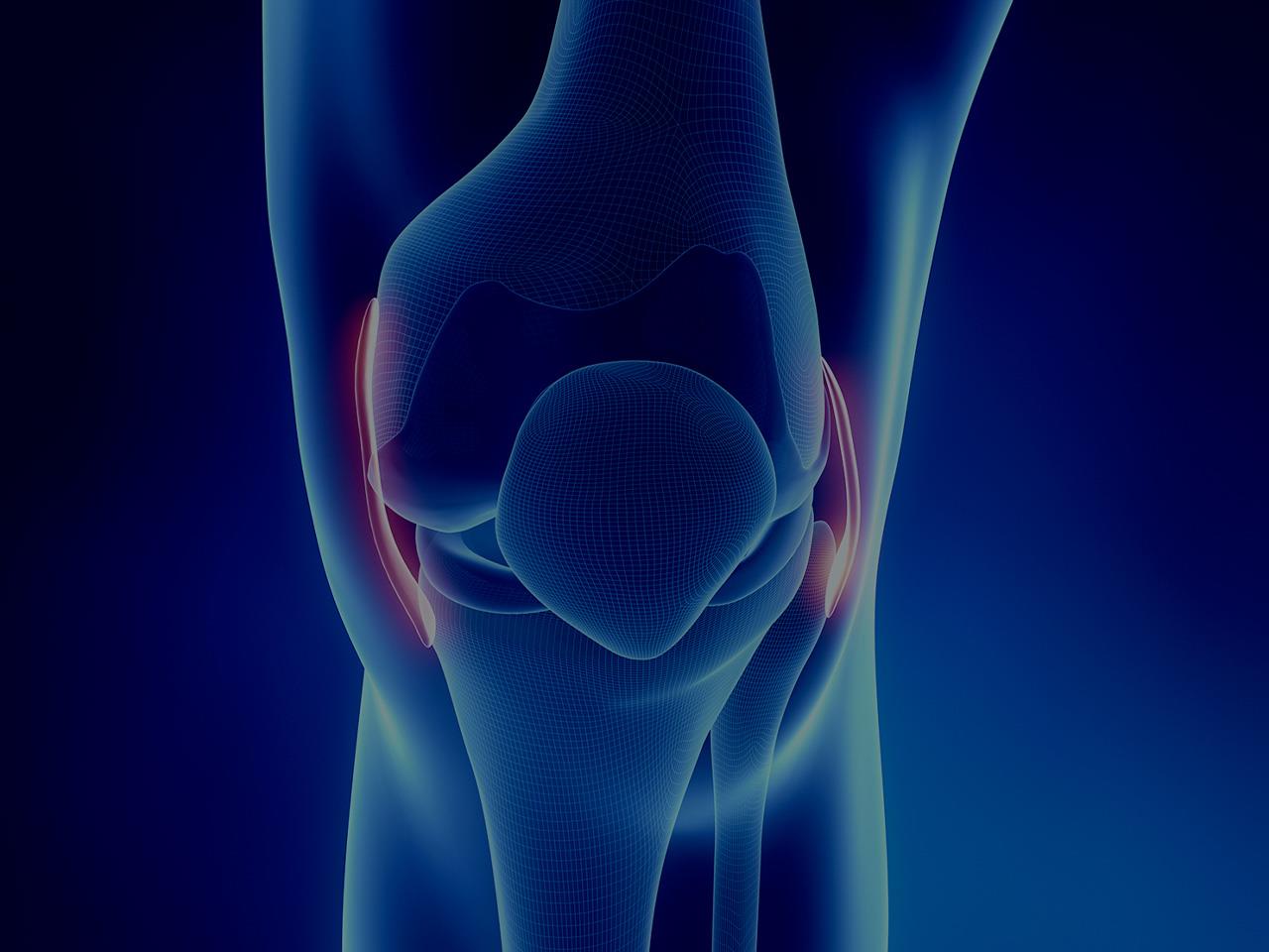 Lateral Meniscus Tear